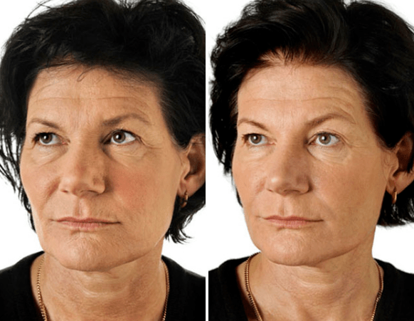 Rezultat frakcijskog pomlađivanja lica