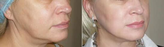 Fotografija nakon primjene postupka