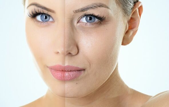 Indikacije za frakcijsko pomlađivanje