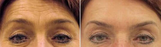 Pomlađivanje polja čela